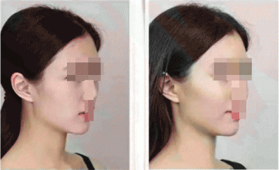 ​皮肤松弛苹果肌下垂怎么办