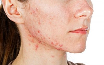 ​花粉过敏导致脸上起红疙瘩 该怎么办