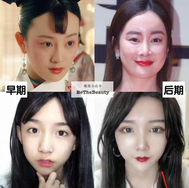 全脸整容恢复过程（越整越自然的脸）(6)