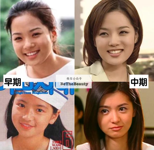 全脸整容恢复过程（越整越自然的脸）(34)