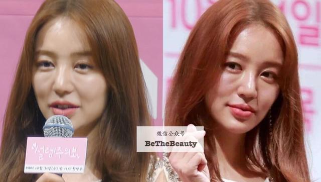 全脸整容恢复过程（越整越自然的脸）(41)