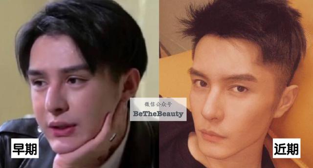 全脸整容恢复过程（越整越自然的脸）(24)