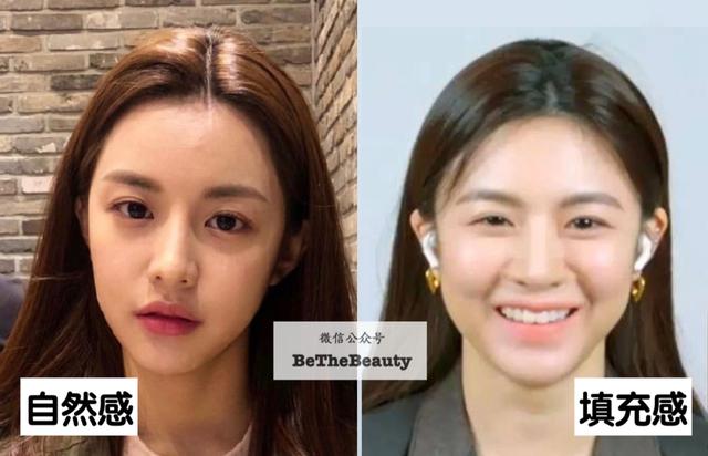 全脸整容恢复过程（越整越自然的脸）(50)