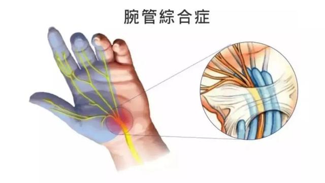 鼠标手型选择(7招拯救你的鼠标手)(6)