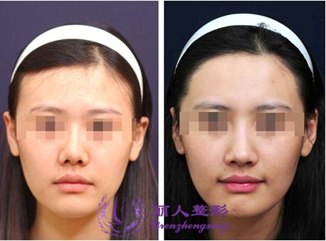 朝天鼻整容后反弹了(朝天鼻整容的术后表现)