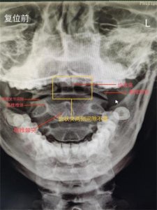 ​小伙反复头痛 4 年，竟是颈部关节惹的祸