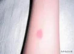 守宫砂为什么会在同房后消失(守宫砂没了还能再点吗)