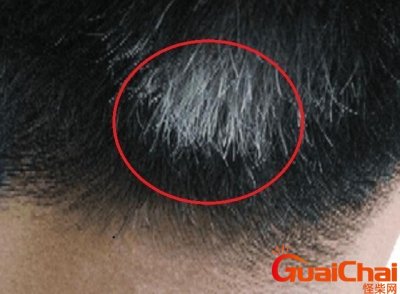 ​三个部位长白发最危险怎么调理好？三个部位长白发最危险图片
