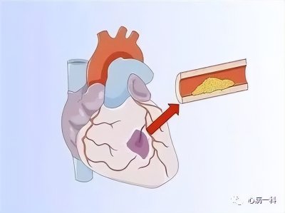 ​变异性心绞痛 如何识别不稳定的心绞痛