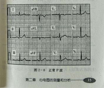 ​正常心电图波形特征和正常值