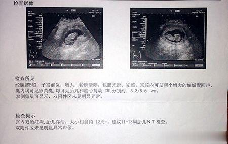 产检时B超单上3个“小数据”，或许在告诉我们胎儿的“性别”！