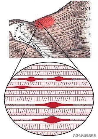 肌肉疼痛的原因和解决方法（肌肉与疼痛原因）(7)