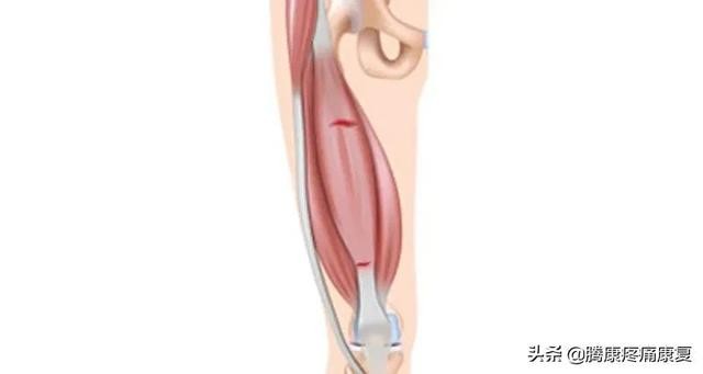 肌肉疼痛的原因和解决方法（肌肉与疼痛原因）(4)