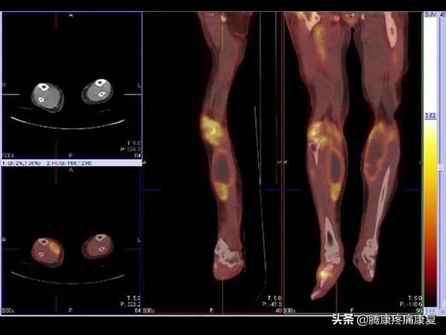 肌肉疼痛的原因和解决方法（肌肉与疼痛原因）(9)