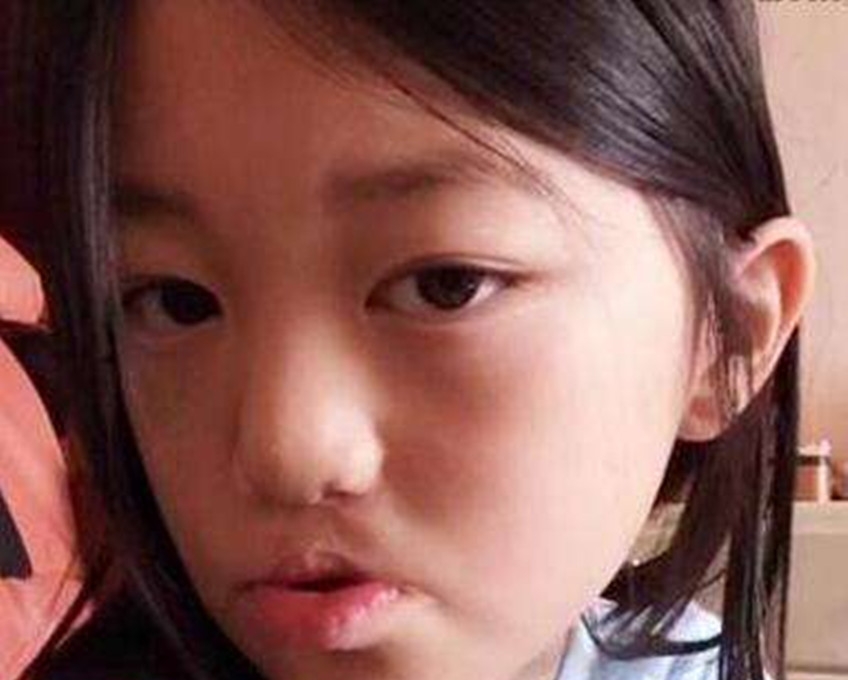 王菲的女儿为什么是兔唇(王菲为什么生下唇裂)  第6张