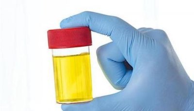 ​为什么尿液有时候是黄的有时候是白的(尿液有时候白色,有时候发黄)